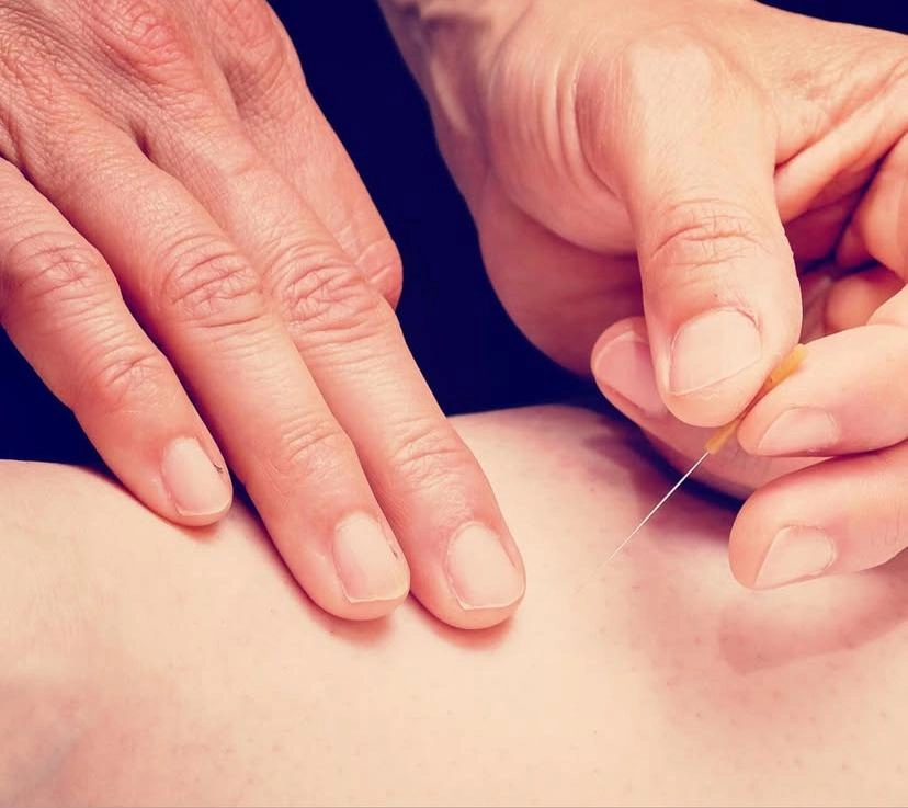 Akupunktur anvendes på huden